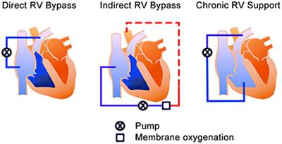 Mechanical circulatory support devices and treatment strategies for right heart failure